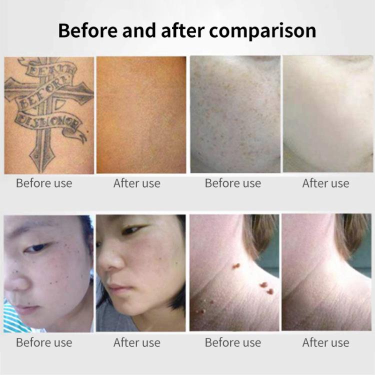 AA-A401 Portable Laser Beauty Instrument Mole Removal Freckle Removal Beauty Laser Pen