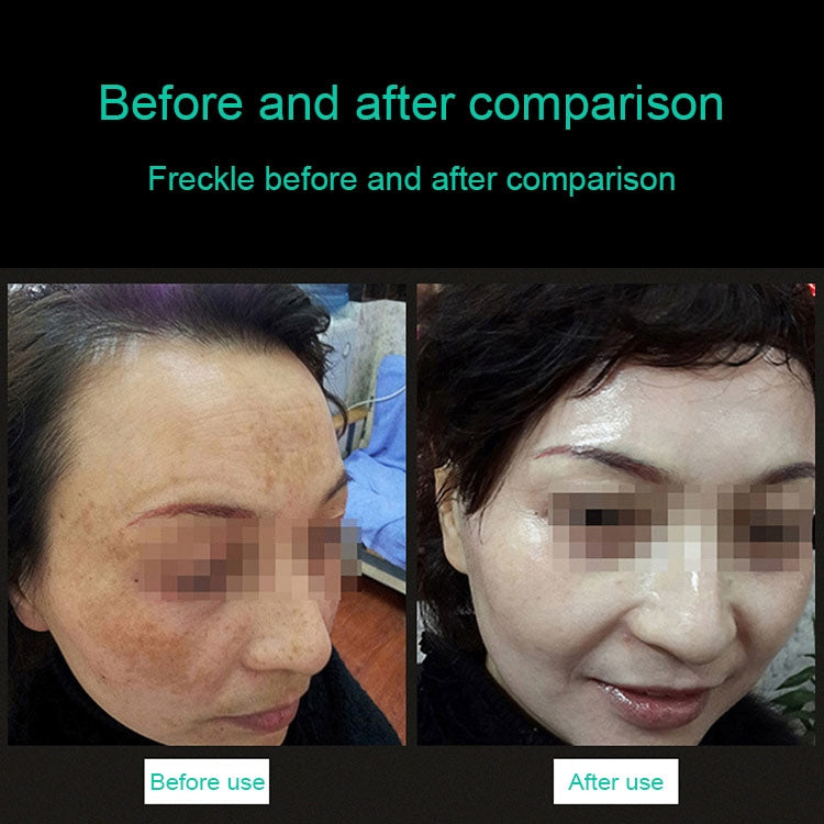 Handheld Picosecond Portable (Removing Tattoo Freckle Mole Dot)  Machine Laser Plasma Beauty Care Pen