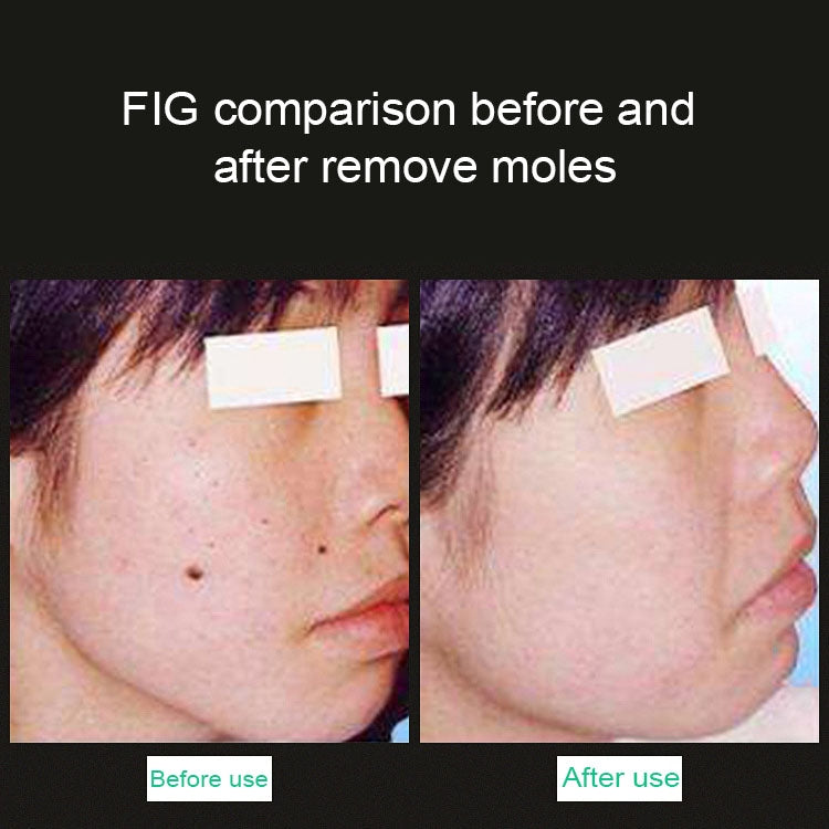 Handheld Picosecond Portable (Removing Tattoo Freckle Mole Dot)  Machine Laser Plasma Beauty Care Pen