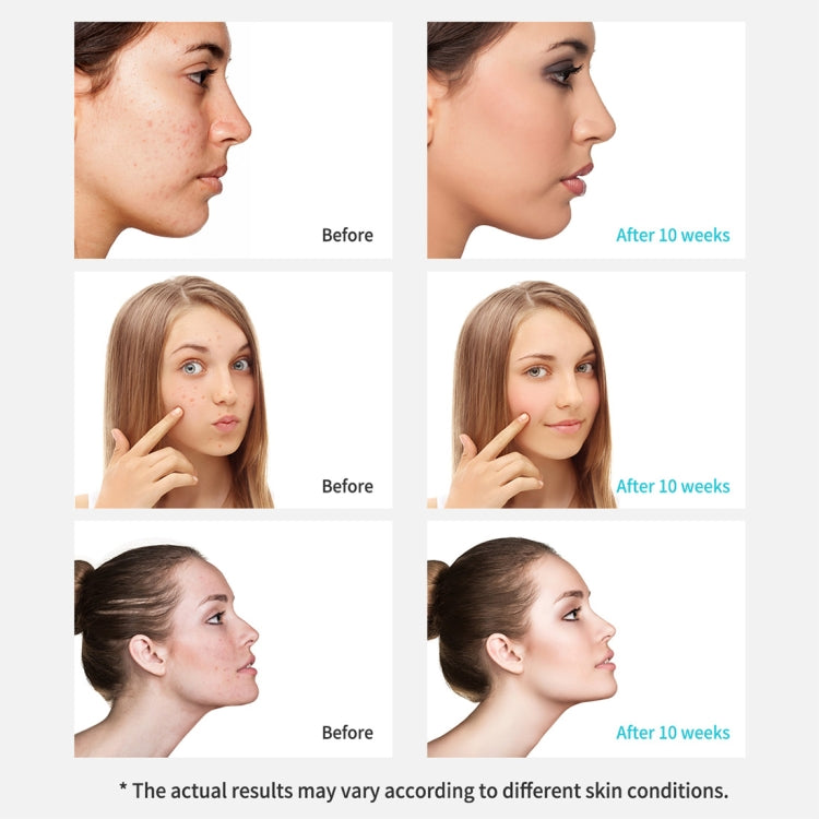 Xpreen Rechargeable Pore Cleanser Home Facial Beauty Device with LED Screen & 4 Probes