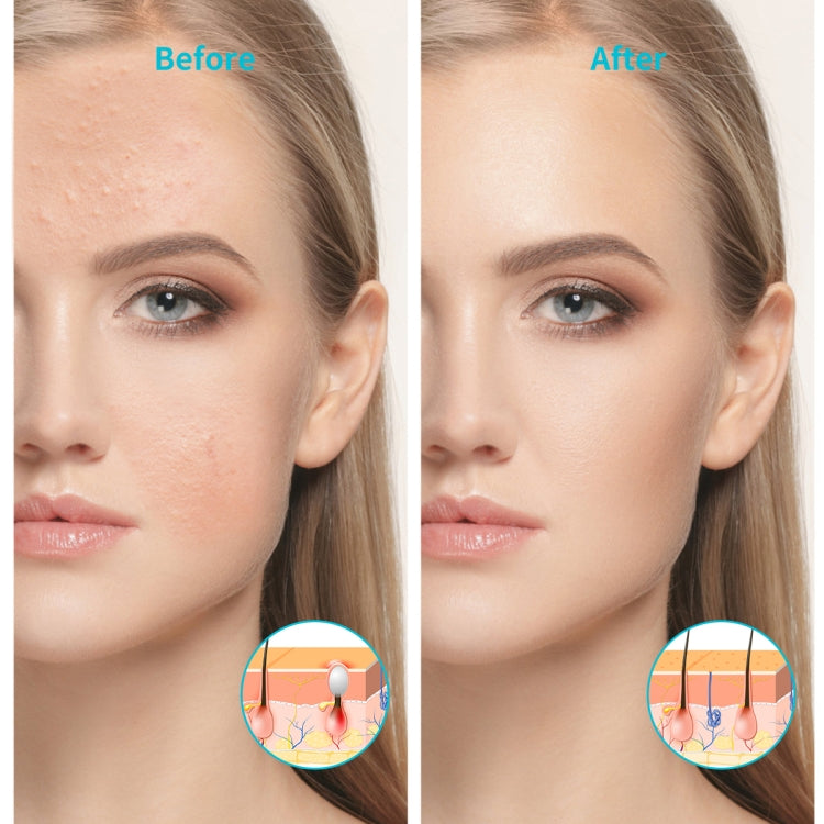 XPREEN XPRE052 Wireless Rechargeable Light Acne Treatment Device Home Acne Clearing Eraser with Blue Light and Red Light