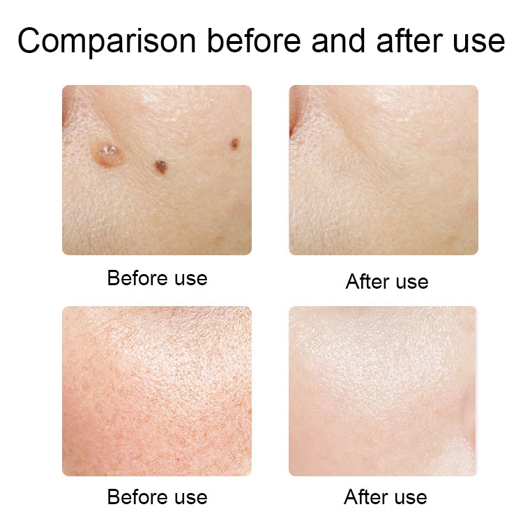 FY-106 Portable Mole and Freckle Removal Pen Household Laser Beauty Equipment