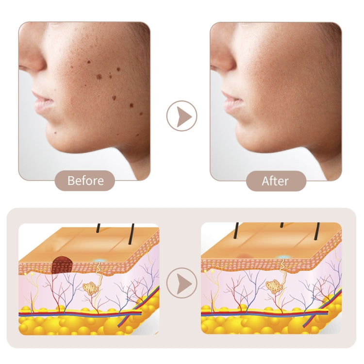 15 Gears Rechargeable Mole Spotting Pen Laser Beauty Instrument Spot Removal Magic Tool